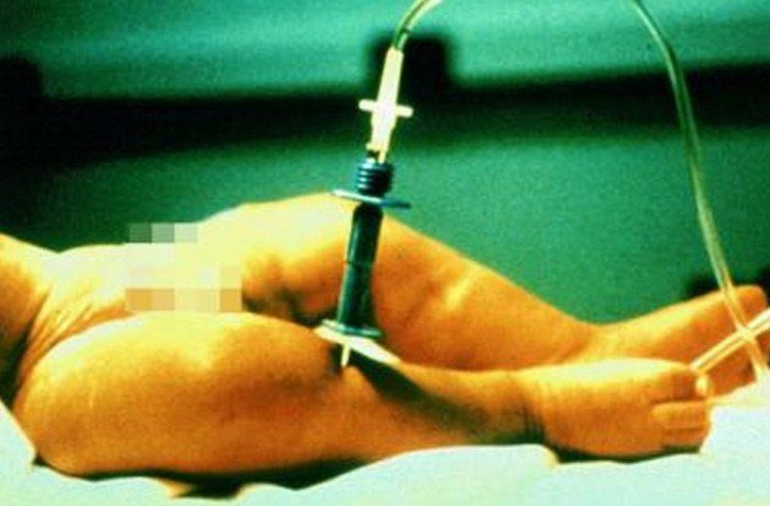 Варварские медицинские процедуры, которые практикуются до сих пор Варварские медицинские процедуры, которые практикуются до сих пор