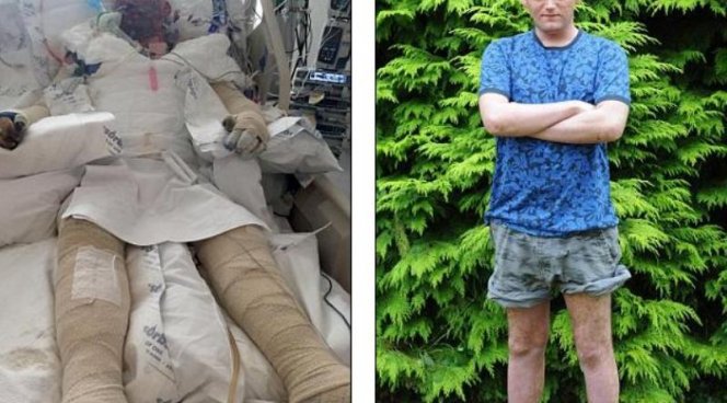 Парень буквально сгорел заживо из-за жуткой аллергии Парень буквально сгорел заживо из-за жуткой аллергии