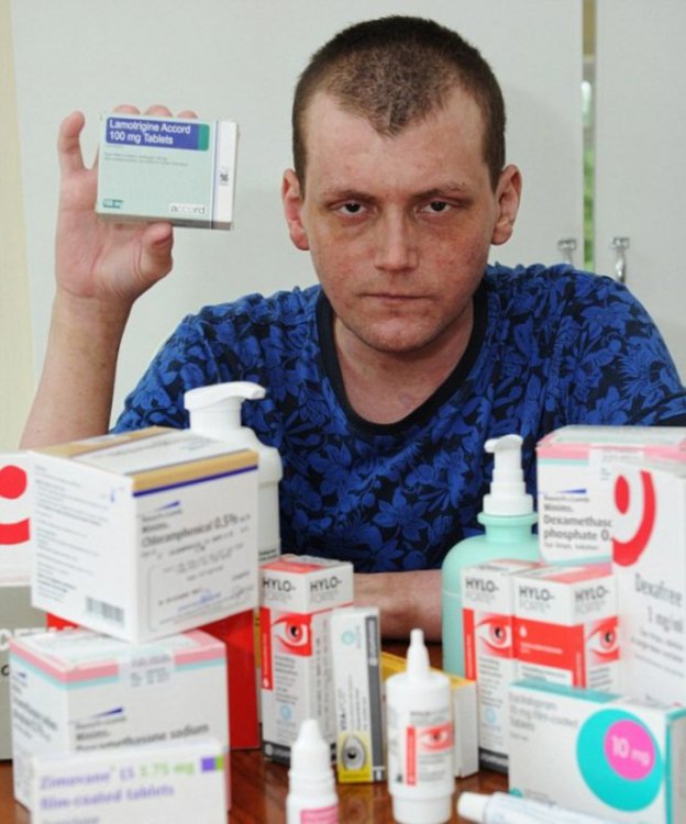 Парень буквально сгорел заживо из-за жуткой аллергии Парень буквально сгорел заживо из-за жуткой аллергии