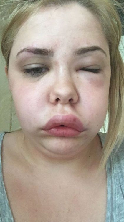 При переживаниях лицо и шея девушки увеличиваются вдвое При переживаниях лицо и шея девушки увеличиваются вдвое