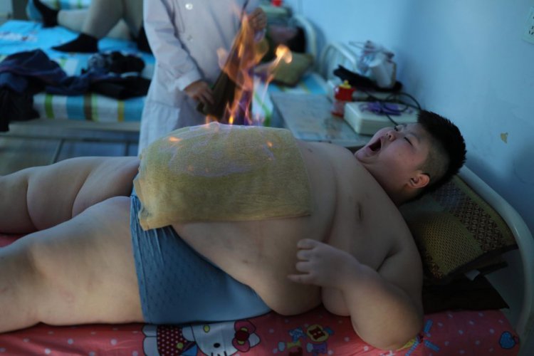 Ради лечения ожирения 11-летнего ребенка решили поджечь Ради лечения ожирения 11-летнего ребенка решили поджечь